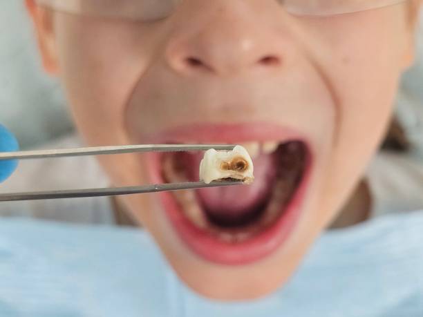 Best Broken or Cracked Tooth Emergency Dentist in Carrollton, TX